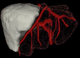 Liver Transplant 
Visualization