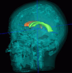 transp. head with ventricles