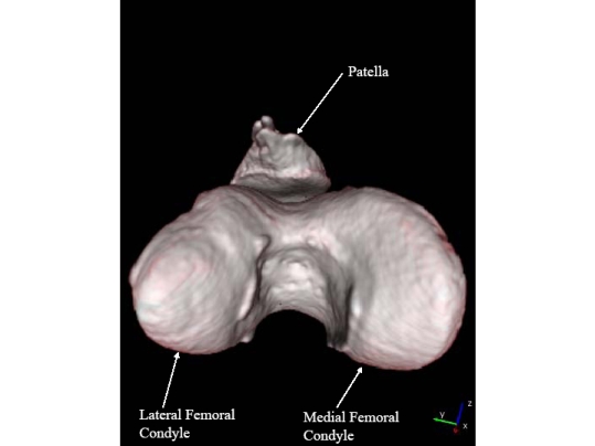 femoral condyle lesion