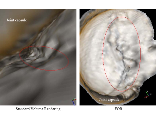 Hill Sachs Lesion