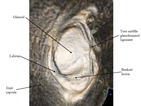 Shoulder Socket Survey View