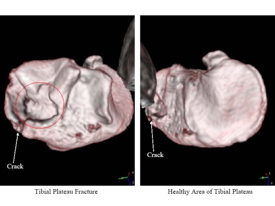 Tibial Plateau Fracture